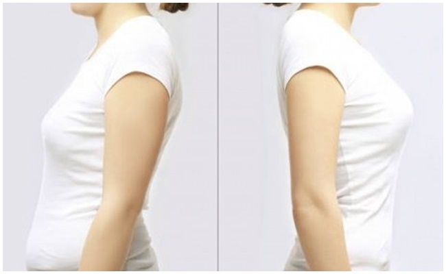 thu gọn ngực chảy xệ