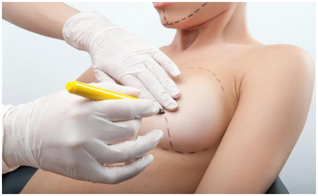 hậu quả nâng ngực