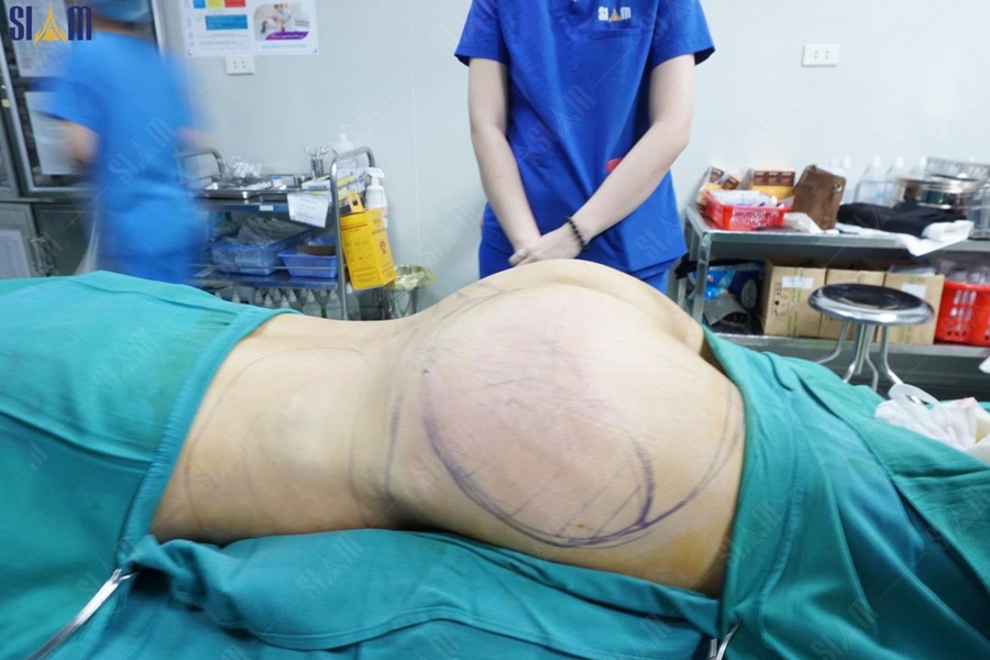 Nâng mông bằng mỡ tự thân